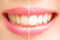 How To Use At Home Teeth Whitening Kits